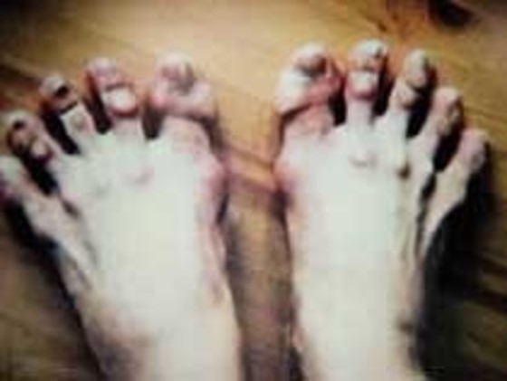 엄청난 연습량을 보여주는 발레리나 강수진의 발 사진. 남편 툰츠 셔크만이 찍은 사진이다.