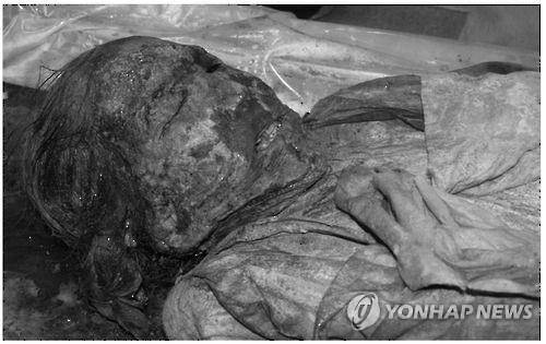 결핵에 걸렸던 것으로 의심되는 350년 전 조선시대 중년 여성 미라 [대한의학회지 논문 캡쳐]