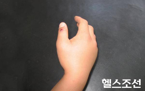 [헬스조선]뱀이 엄지손가락을 물어 생긴 교상.