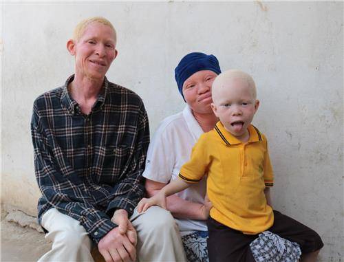 자페티 펠릭스 마사웨(38·왼쪽)와 아그넬라 엘리아스(36·가운데), 타데우스 자페티(4). 가족 모두가 알비노(백색증 환자)다. (다르에스살람=연합뉴스)