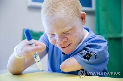 공격을 받아 한쪽 팔을 잃은 탄자니아의 알비노 어린이 (AP=연합뉴스)