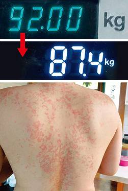 ‘저탄고지’ 다이어트 일주일 만에 몸무게는 총 4.6kg 빠졌고, 허리둘레는 4cm 줄었다(위) [박세준 기자] . 8일 차 아침에 발진이 심해져 의사 권유로 다이어트를 중단했다. [박세준 기자]