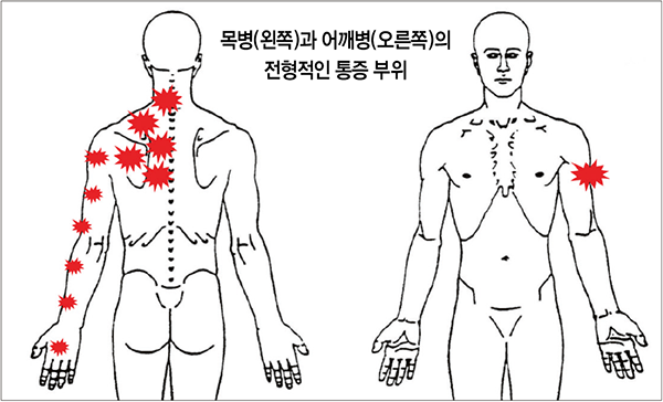 반면 목 디스크 탈출증이 원인일 경우 통증 범위가 광범위하다