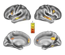 엄마는 출산 과정을 겪으며 뇌의 회백질 부피가 줄어들고 이는 출산 후 2년 뒤까지 유지된다. 왼쪽 사진의 노란색 부분은 출산 후 회백질이 줄어든 부위를 나타낸다. 이는 2년 뒤까지 유지되는 것으로 나타났다(오른쪽 사진, 노란색). 노란색은 빨간색으로 표시된 부분보다 회백질 크기 변화가 통계적으로 더 유의한 것을 나타낸다. 사진: 네이처 뉴로사이언스