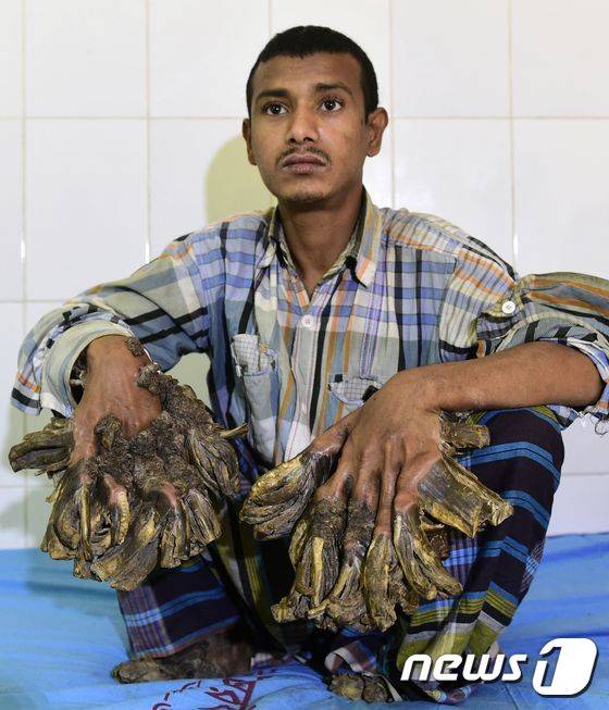 지난해 1월 수술을 받기 전 진료를 위해 방글라데시 다카의 한 병원을 찾은 바한다르의 모습. © AFP=뉴스1