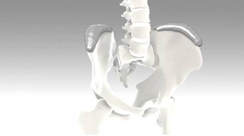 금속과 실리콘 재질의 보형물을 엉덩뼈에 덧대어 고정한 그래픽 [건양대학교병원 제공]