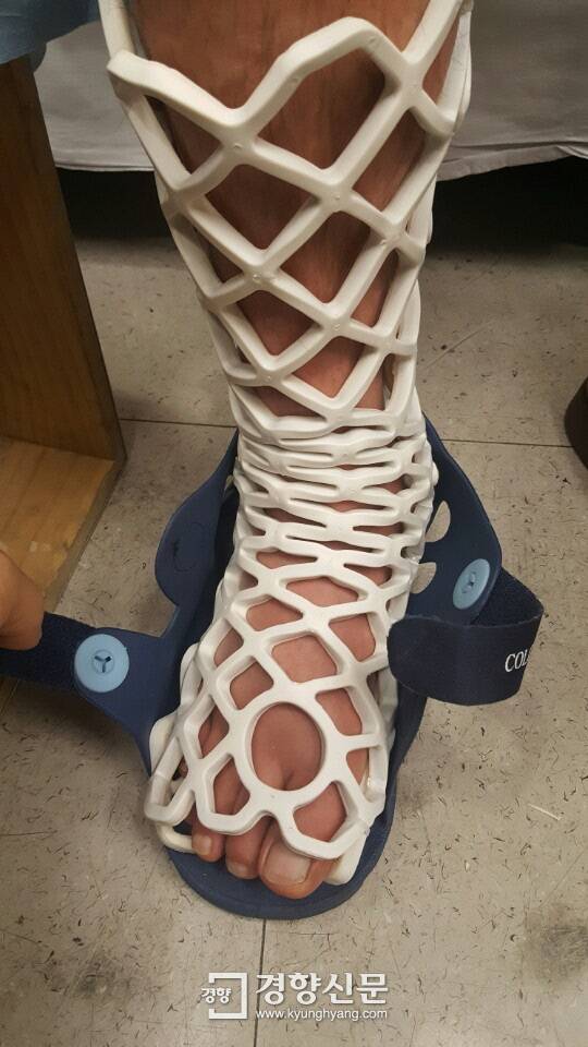 다리 골절 환자가 국내 원천기술로 개발된 신개념 깁스장치인 ‘오픈캐스트’를 착용하고 있다. 우리소재 제공