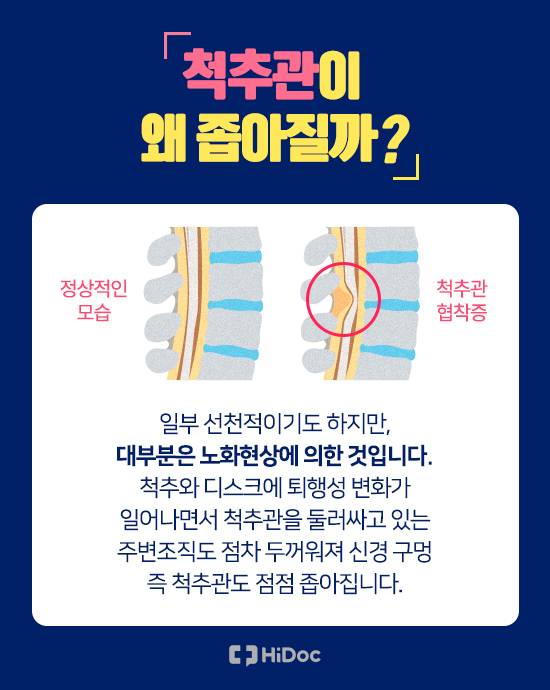 척추관이 왜 좁아질까?