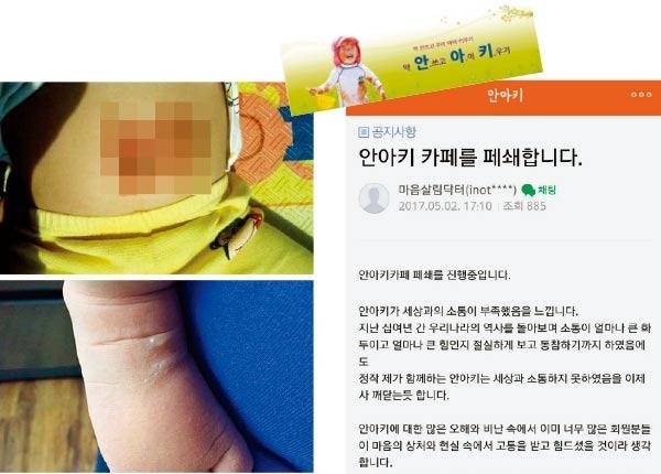 ‘안아키’(약 안 쓰고 아이 키우기) 방식으로 치료하다 부작용이 일어난 아이.(왼쪽), 폐쇄된 ‘안아키’ 인터넷 커뮤니티. [인터넷 커뮤니티 캡처]