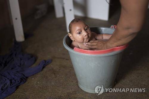브라질의 소두증 신생아(AP=연합뉴스 자료사진)