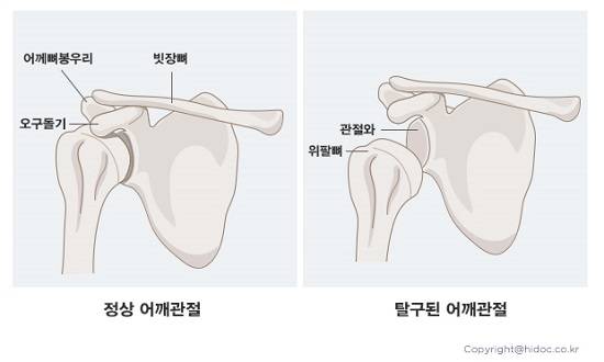 정상 어깨뼈와 탈골된 어깨뼈