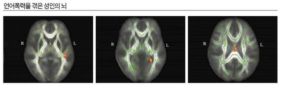 기능성 뇌 자기공명영상장치(FMRIB)로 찍은 뇌 영상. 빨간 부분은 정보를 전달하는 백질의 경로가 좁아진 부분을 가리킨다. 이 곳이 좁아지면 언어지능이 떨어지고(왼쪽), 우울증·의식분열(가운데), 불안장애(오른쪽)의 위험이 높아진다.