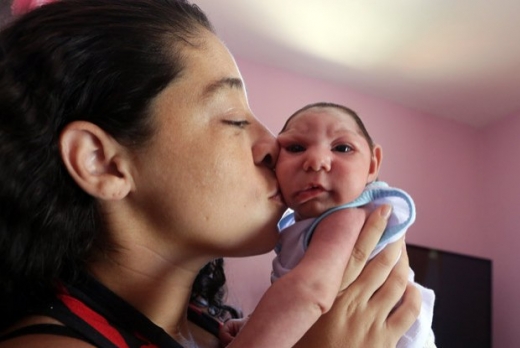 지카 바이러스로 인한 소두증을 갖고 태어난 아기의 모습.(자료사진)