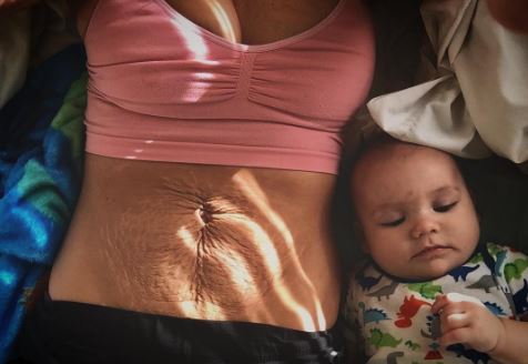 알렉산드라 킬머레이씨는 출산 18개월 후, 임신튼살을 인스타그램에 올렸다. 이 사진은 전세계적으로 화제가 되었다. /사진=인스타그램 사진 캡처.