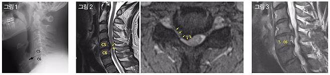 정선근 교수의 목 디스크 엑스레이(그림 1)와 MRI(그림 2, 그림 3). (그림 1) 심한 일자 목이다. (그림 2) 5-6번 목 디스크가 척추를 누르고 있다. (그림 3) 6번 목뼈 위쪽 종판도 손상되었다.