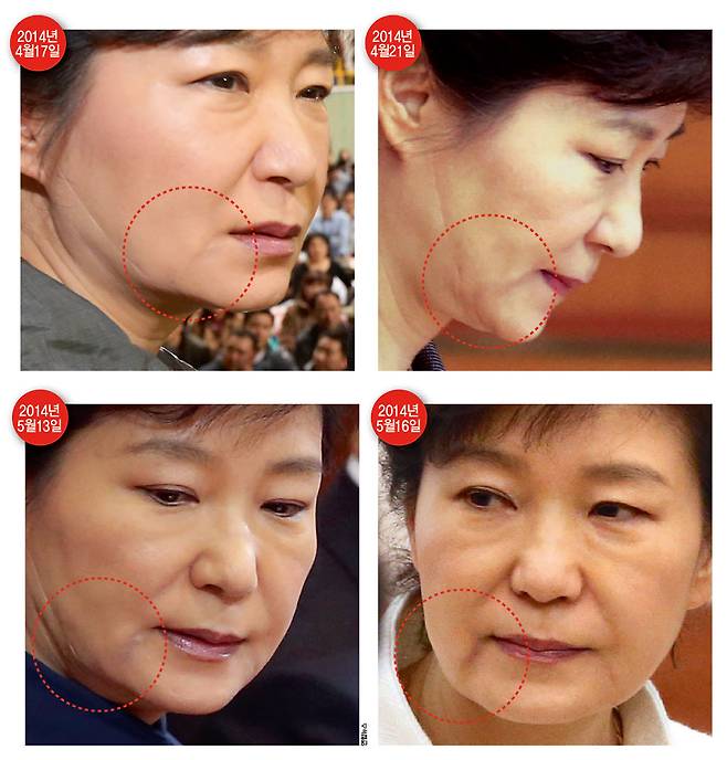세월호 참사 이후인 2014년 4월17일, 4월21일, 5월13일, 5월16일 한 달 동안의 박근혜 대통령 사진을 보면 얼굴에 미용 주사로 인한 멍 자국이 선명하게 나 있다.