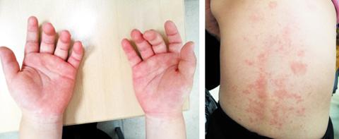 [헬스조선]가와사키병에 의해 손발이 붓고 몸에 두드러기가 올라온 사진/사진=강남세브란스병원 제공