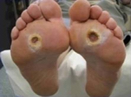 당뇨발                                                                             /사진제공=서울아산병원