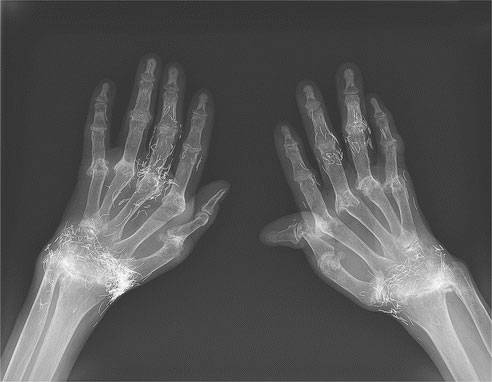 손 안 ‘금침’ 빽빽…한국 50대女 엑스레이, 국제학술지 실려