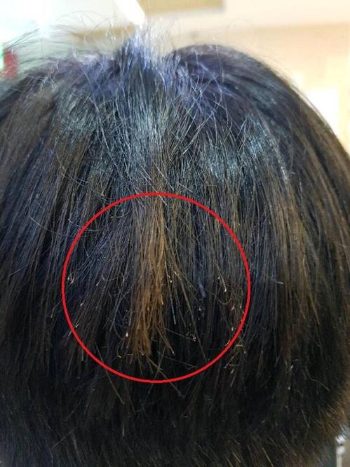 불로 지진 머리[피해자 제공=연합뉴스]