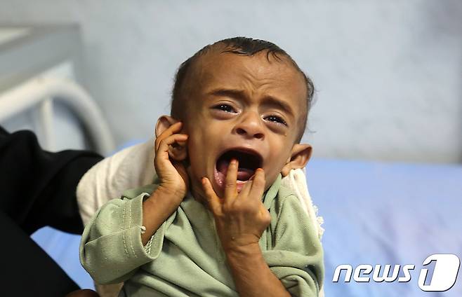 영양실조로 병원에서 치료받고 있는 예멘 어린이. (자료사진) © AFP=뉴스1