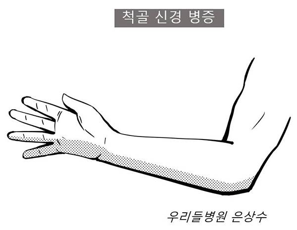 내상과염 근력강화 운동 / 사진-은상수 전문의 제공