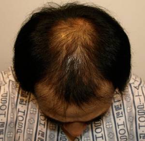 유전에 의한 탈모 사례 2. 정수리와 이마의 탈모 부위가 서로 연결돼가고 있는 모습.