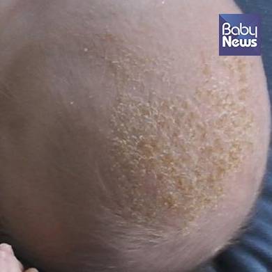 아기머릿기름딱지(사진 8). ⓒ박준수