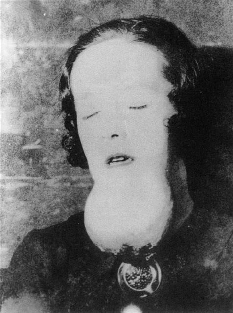 라듐에 피폭된 한 여성의 턱에 커다란 육종이 생긴 모습.사일런스북 제공
