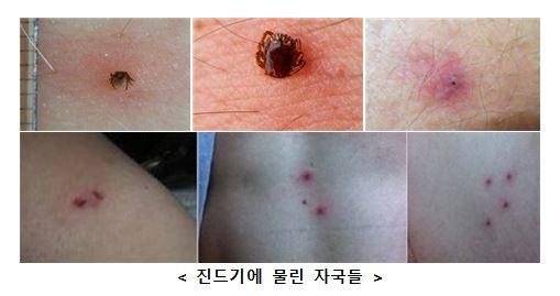 야생진드기에 물린 자국들