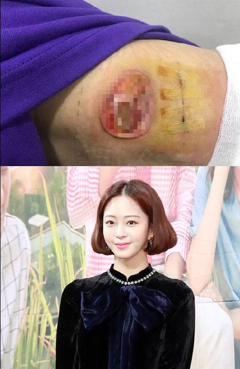 한예슬 지방종 수술 부위 (사진=한예슬 SNS, 이데일리DB)