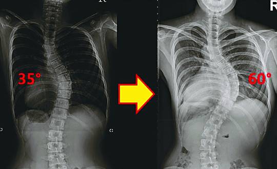 중학교 1학년 때 35도로 등뼈가 휘어져 있다는 진단을 받은 후 12년간 방치했다가 최근 병원을 찾은 25세 여성의 척추X선 촬영 영상. 척추가 60도로 더 휘어져 심각한 상태임을 알 수 있다.고려대 구로병원 제공