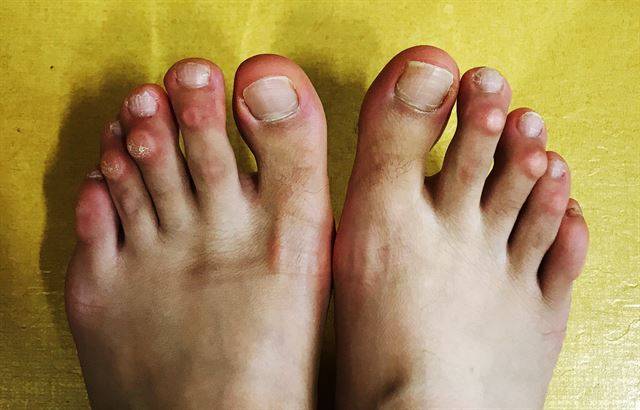 판매직 여성 노동자의 발. 발가락 마디마다 딱딱한 구두에 짓눌려 생긴 굳은살이 박였다.