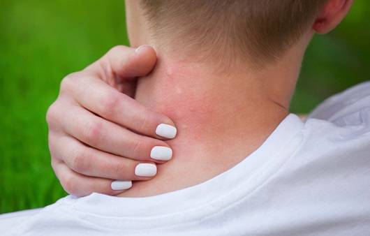 여름철 피부 질환 2