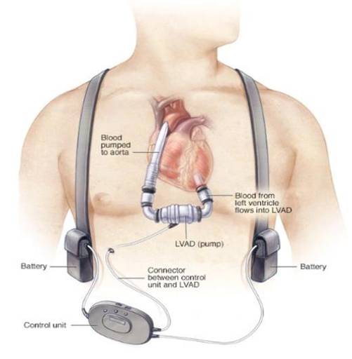 이식형 좌심실 보조장치 치료술. /보건복지부 제공