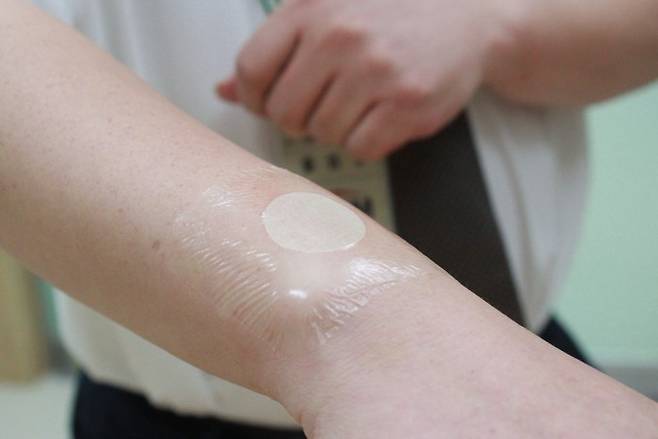 한국기계연구원이 개발한 ‘나노·마이크로 DNA 니들패치’를 피부에 붙인 모습. 주삿바늘 대신 체내에 약물을 전달해 줄 수 있다. - 대전=송경은 기자 kyungeun@donga.com
