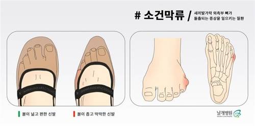 소건막류 [날개병원 제공=연합뉴스]