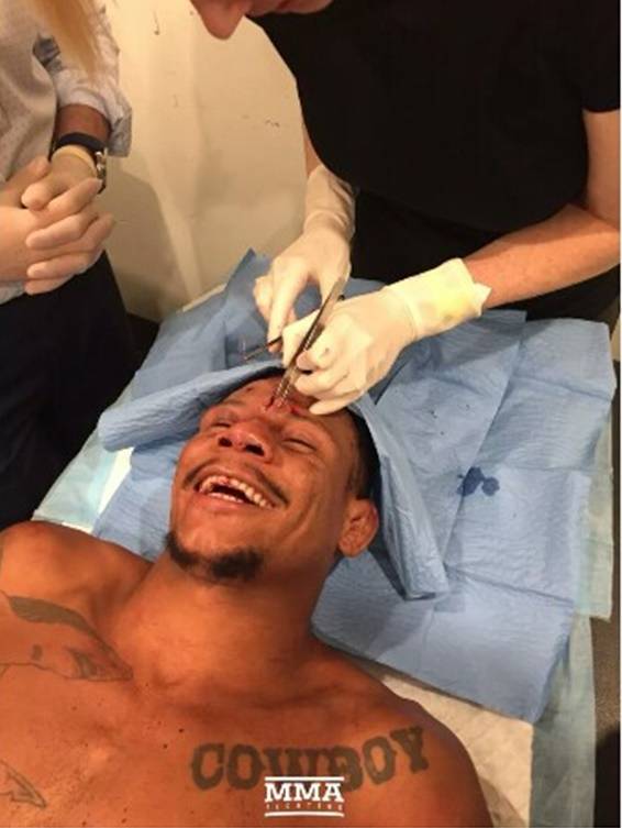 ▲ 혈전 후유증에도 미소를 잃지 않는 알렉스 올리베이라 ⓐ MMA 파이팅 캡처