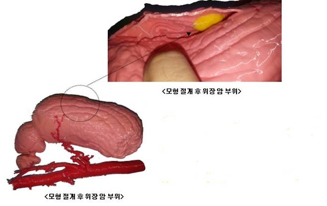 쓰리디코리아가 자사 3D프린터로 출력한 사전 모의 수술용 컬러 장기 모형. 모형을 절개하면 위장의 암부위를 직접 재현 모습을 볼수 있다.(오른쪽 위)