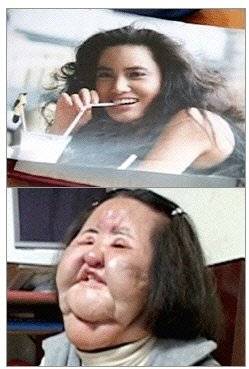 성형수술 전 아름답던 20대 모습(우)과 성형 부작용으로 얼굴이 부풀어 오른 모습(아래). 방송화면 캡처.