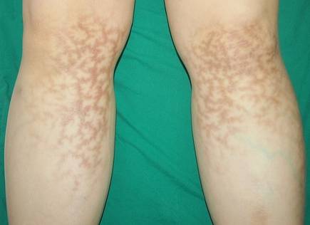 전열기구 사용으로 인해 다리 부위에 저온 화상을 입은 모습. /고려대학교의료원 제공