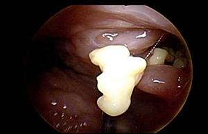 평소 입 냄새가 자주 나거나 목에 이물감이 느껴진다면 편도결석을 의심해볼 필요가 있다./사진=뉴연세이비인후과