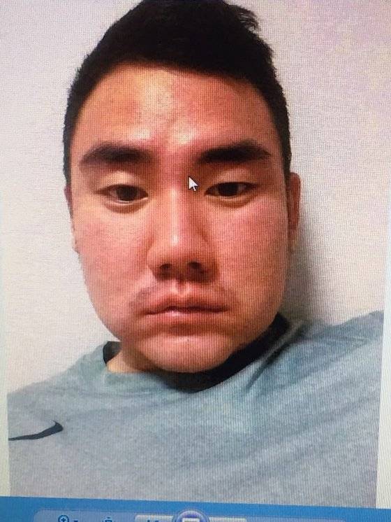 지난 2015년 5월 이택근에게 방망이로 머리를 맞고 얼굴이 부어있는 문우람의 모습. [사진 문우람]