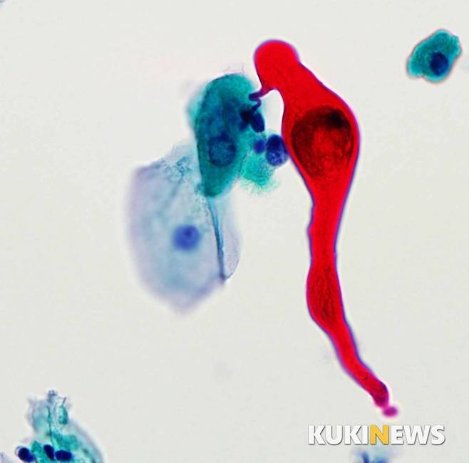 벌새 (a hummingbird) : 빨간 벌새가 꽃에서 꿀을 빨고 있는 모습이다.  이것은 본래 기관지에 발생한 편평세포암을 세포학적 검사로 진단하다 발견했다.