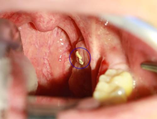 편도결석(파란색 원 부분) [하나이비인후과병원 제공]