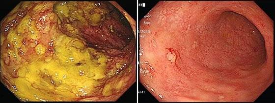 대전성모병원 강상범 교수팀이 2018년 중증 위막성 대장염 환자를 대상으로 대변 세균총 이식을 하기 전(왼쪽)과 이식 이후(오른쪽)의 모습이다. 대변 세균총 이식은 건강한 사람 대변에서 추출한 미생물을 대장염 환자 장에 넣어 장내 미생물 균형을 맞추는 방식이라고 병원 측은 설명했다. <저작권자 ⓒ 1980-2018 ㈜연합뉴스. 무단 전재 재배포 금지.>