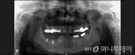 임플란트 실패사례/사진제공=용인세브란스병원치과