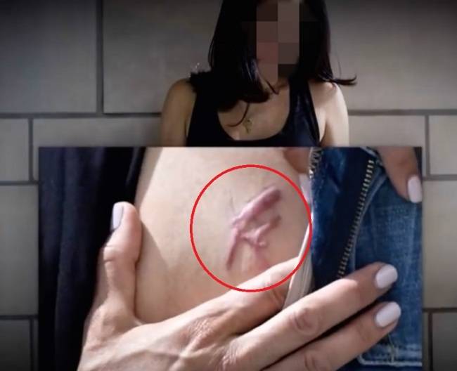 일반여성을 끌여들여 섹스 노예로 삼고 각종 사기 행각 등 범죄를 벌여온 광신집단‘넥시움(NXIVM)’단체 창립자인 키스 라니에르가 여성들 몸에 새긴 이니셜 낙인. [유튜브 영상 캡처]