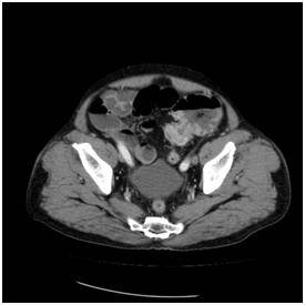 에스자 결장에 생긴 대장암으로 장폐쇄가 생겨서 유발된 변비 [서울대병원 제공]