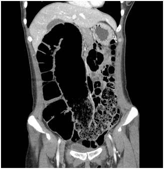 서행성변비 복부 CT 영상. 상행 결장에서 횡행 결장이 심하게 늘어나 있으며 이보다 항문에 가까운 쪽에 대변이 차 있다. 대장 내 종괴 등 폐쇄를 유발하는 원인 병변은 보이지 않는다. [서울대병원 제공]